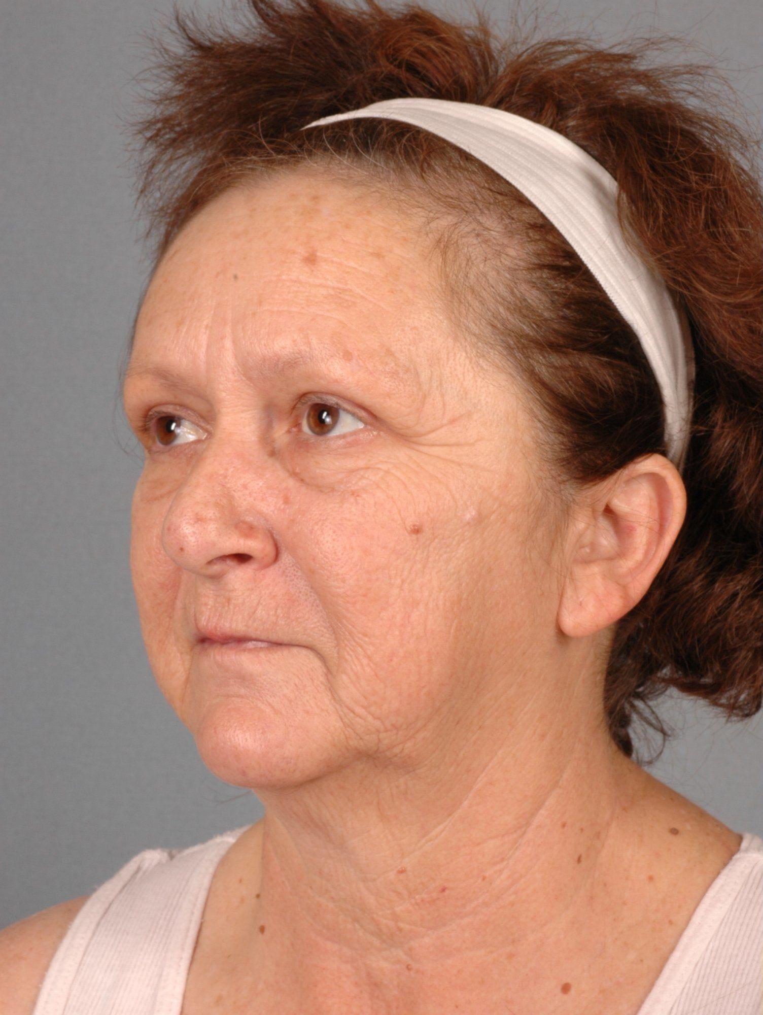 Facelift Patient Photo - Case 15188 - before view-3