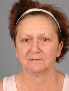 Facelift - Case 15188 - Before