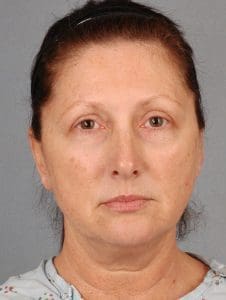Facelift - Case 15200 - Before