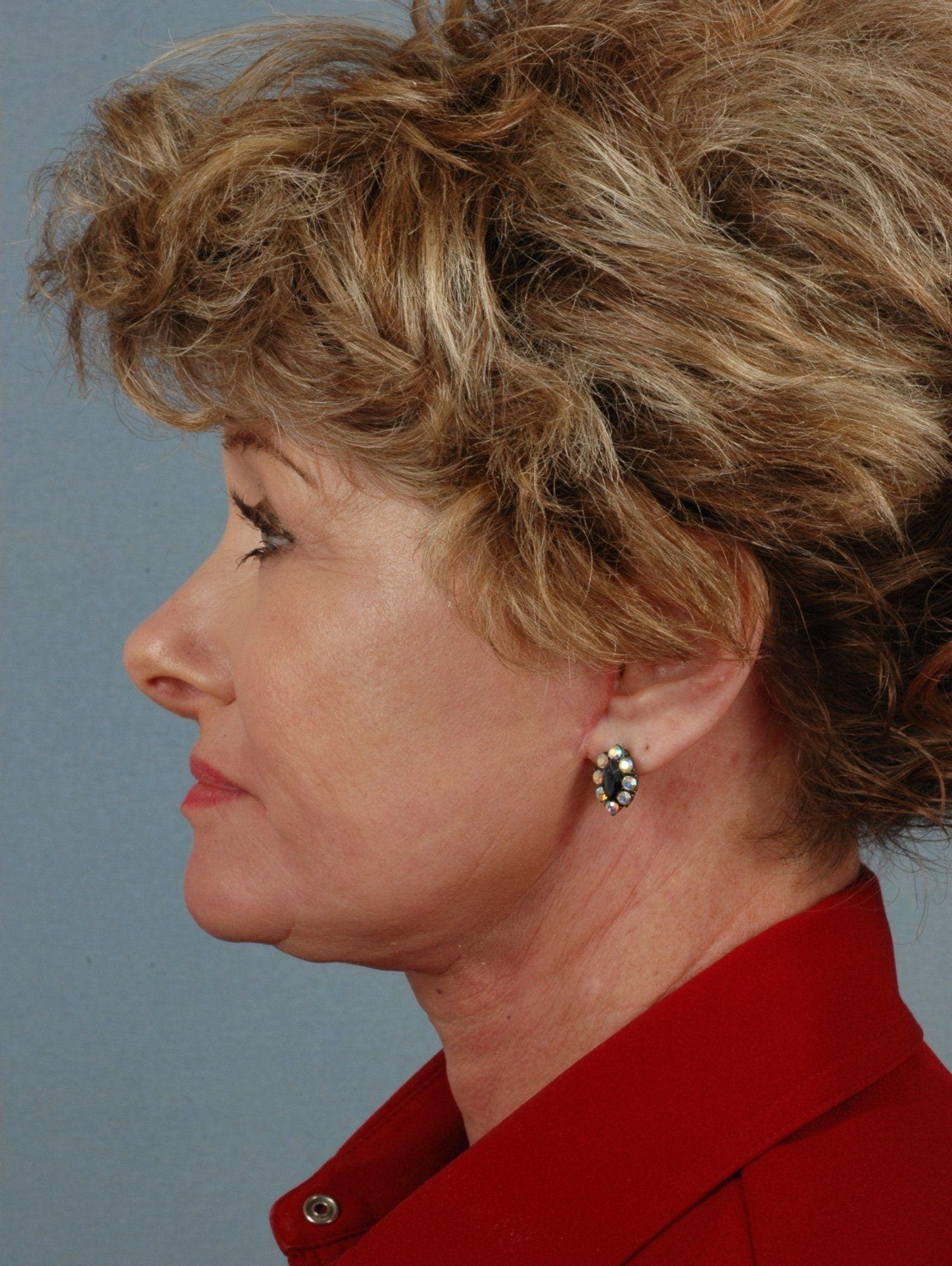 Facelift Patient Photo - Case 15213 - after view-1