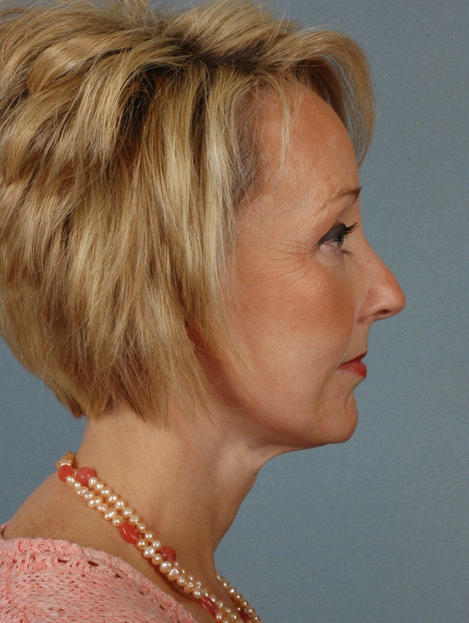 Facelift Patient Photo - Case 15226 - after view-1
