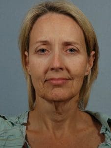 Facelift - Case 15226 - Before