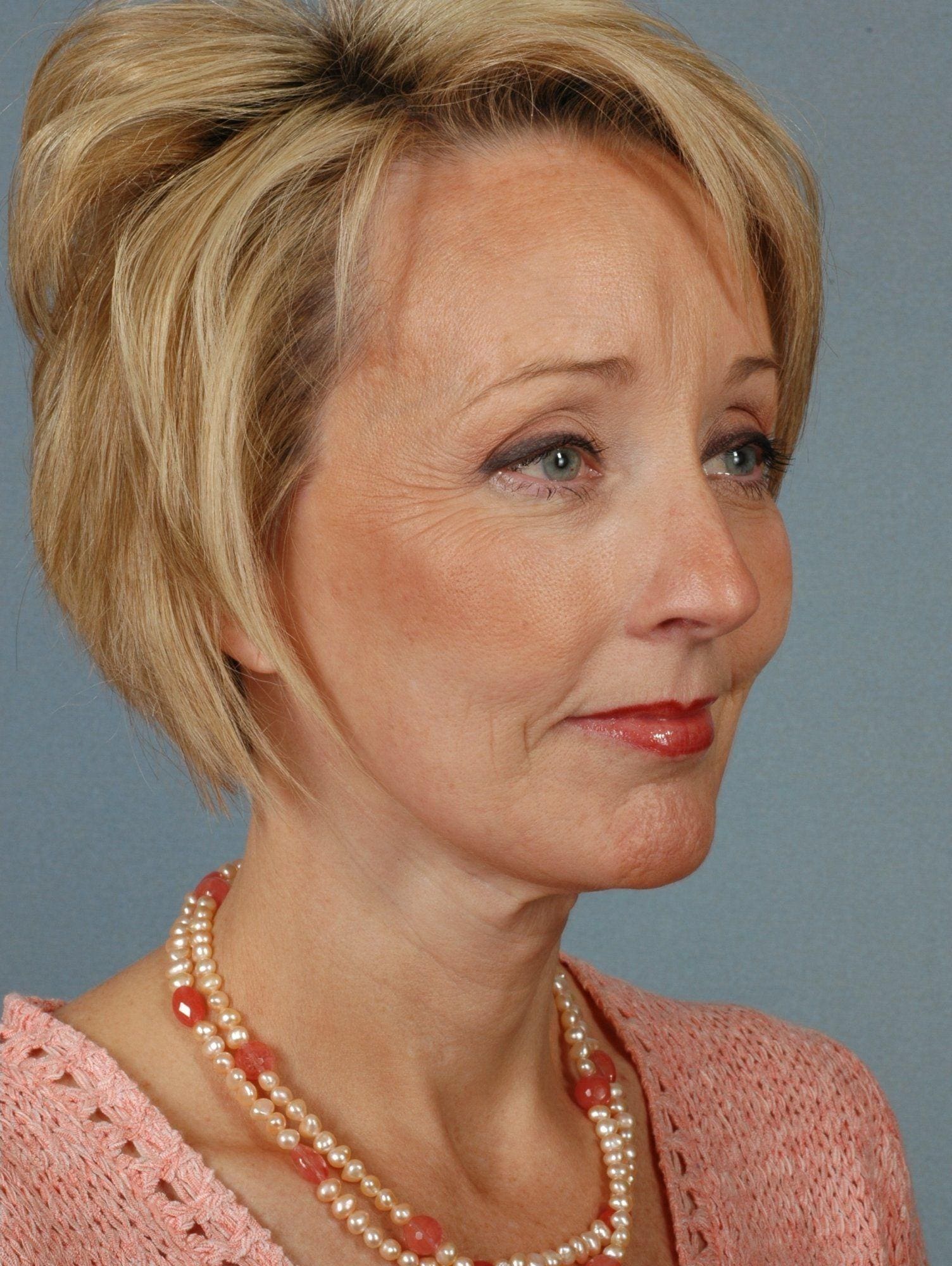 Facelift Patient Photo - Case 15226 - after view-3