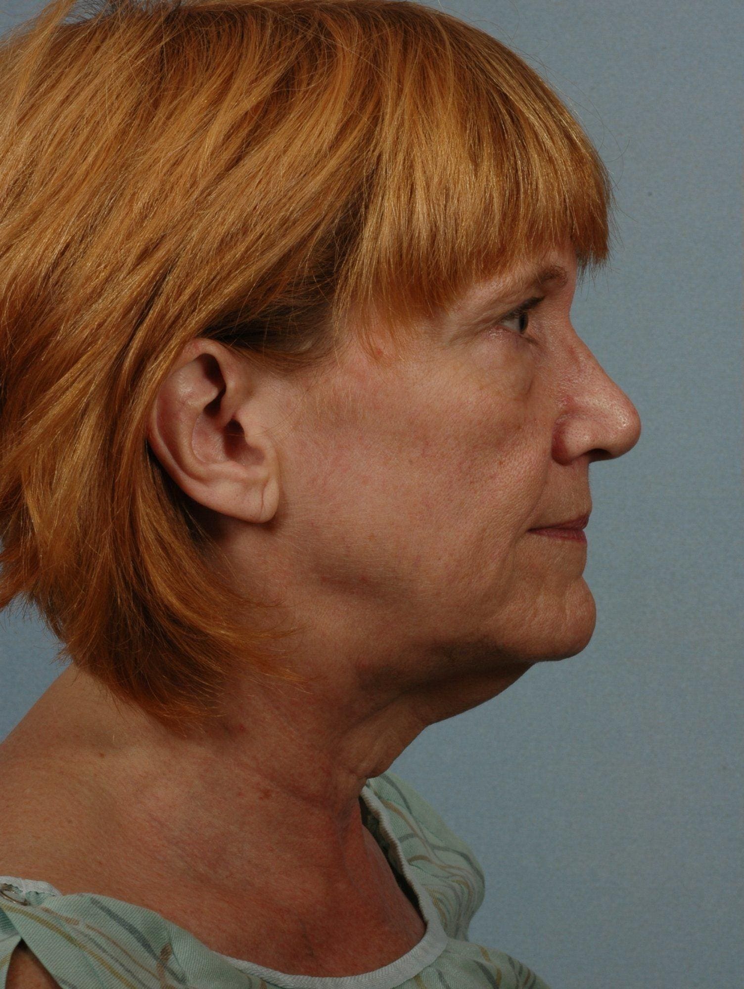 Facelift Patient Photo - Case 15237 - before view-2