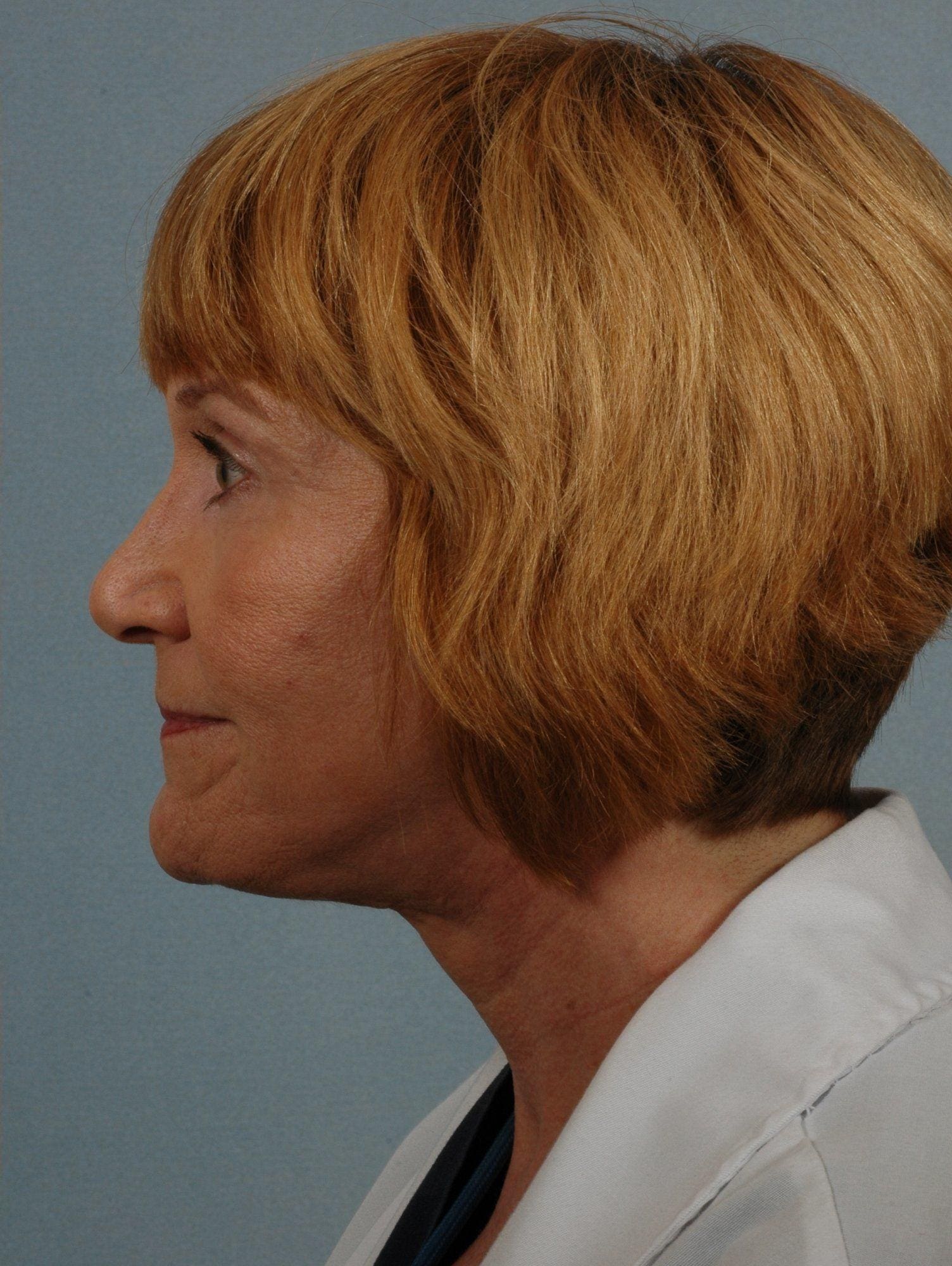 Facelift Patient Photo - Case 15237 - after view-1