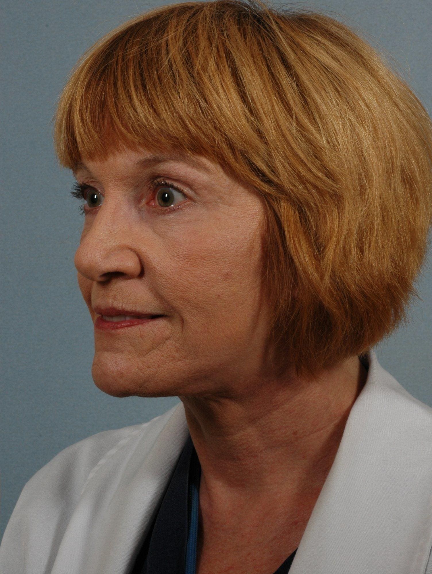 Facelift Patient Photo - Case 15237 - after view-3
