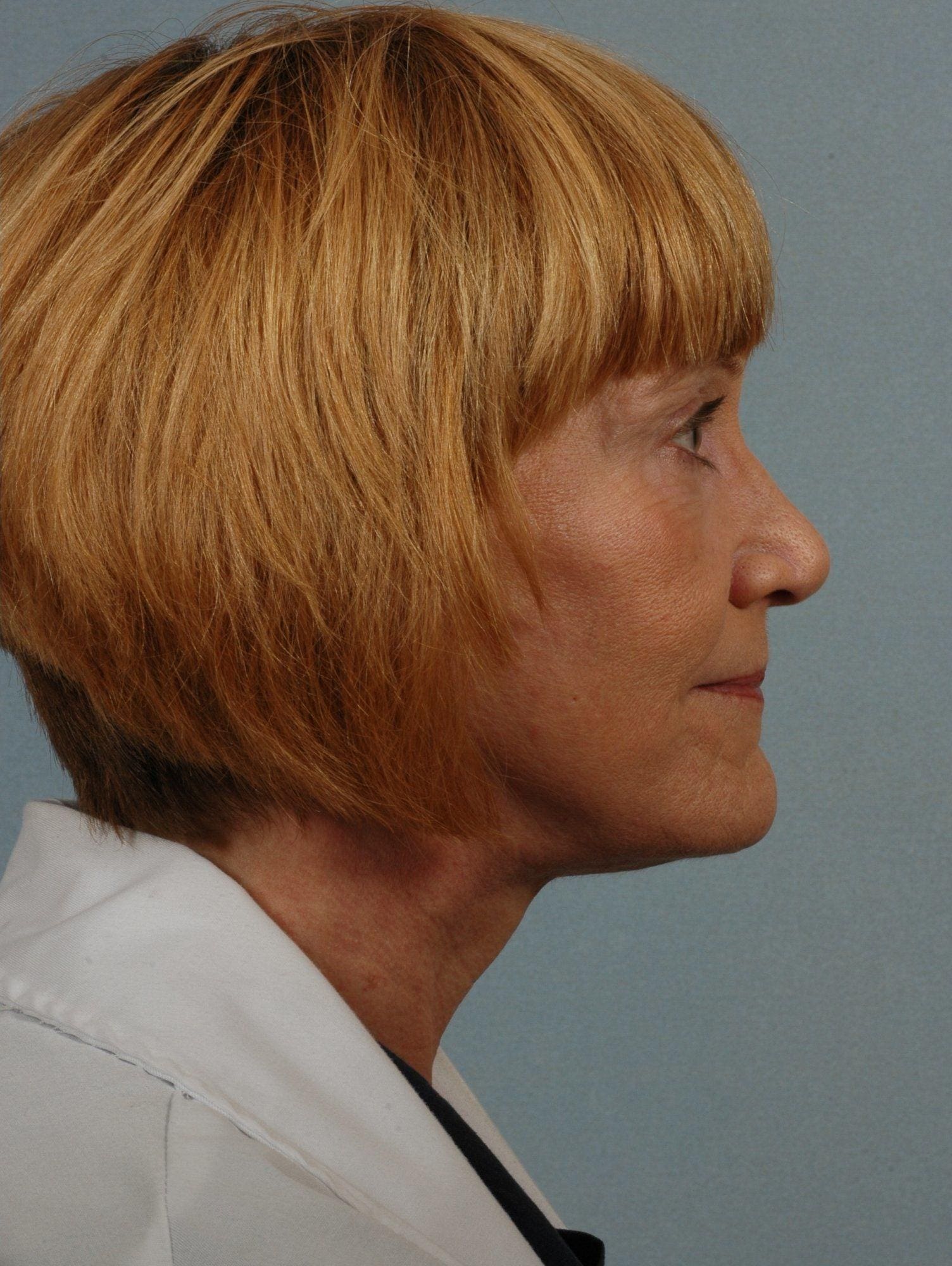 Facelift Patient Photo - Case 15237 - after view-2