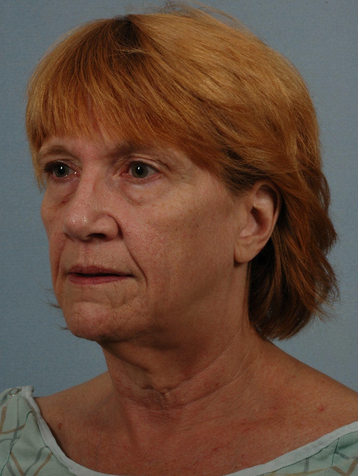 Facelift Patient Photo - Case 15237 - before view-3