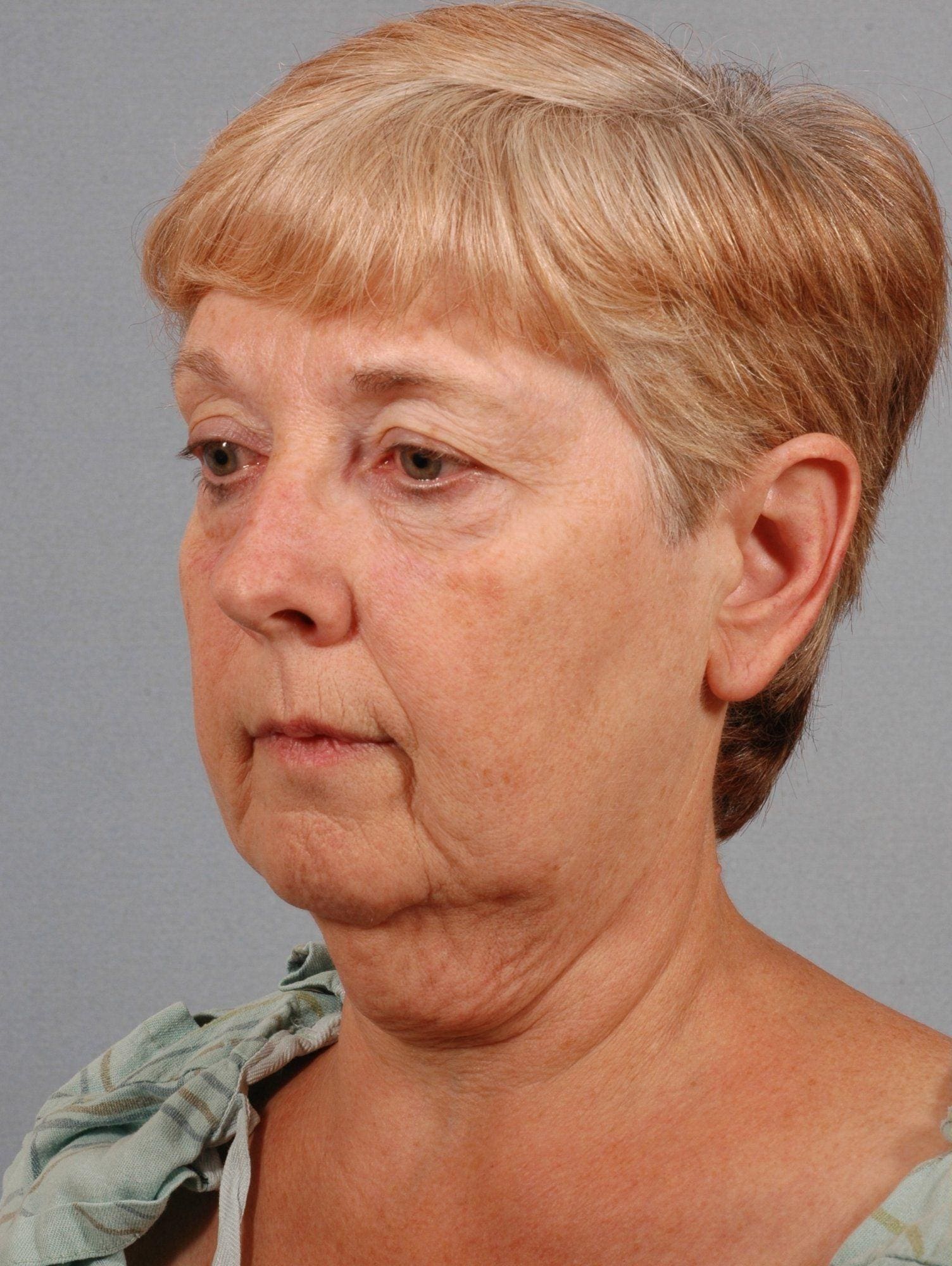 Facelift Patient Photo - Case 15251 - before view-1