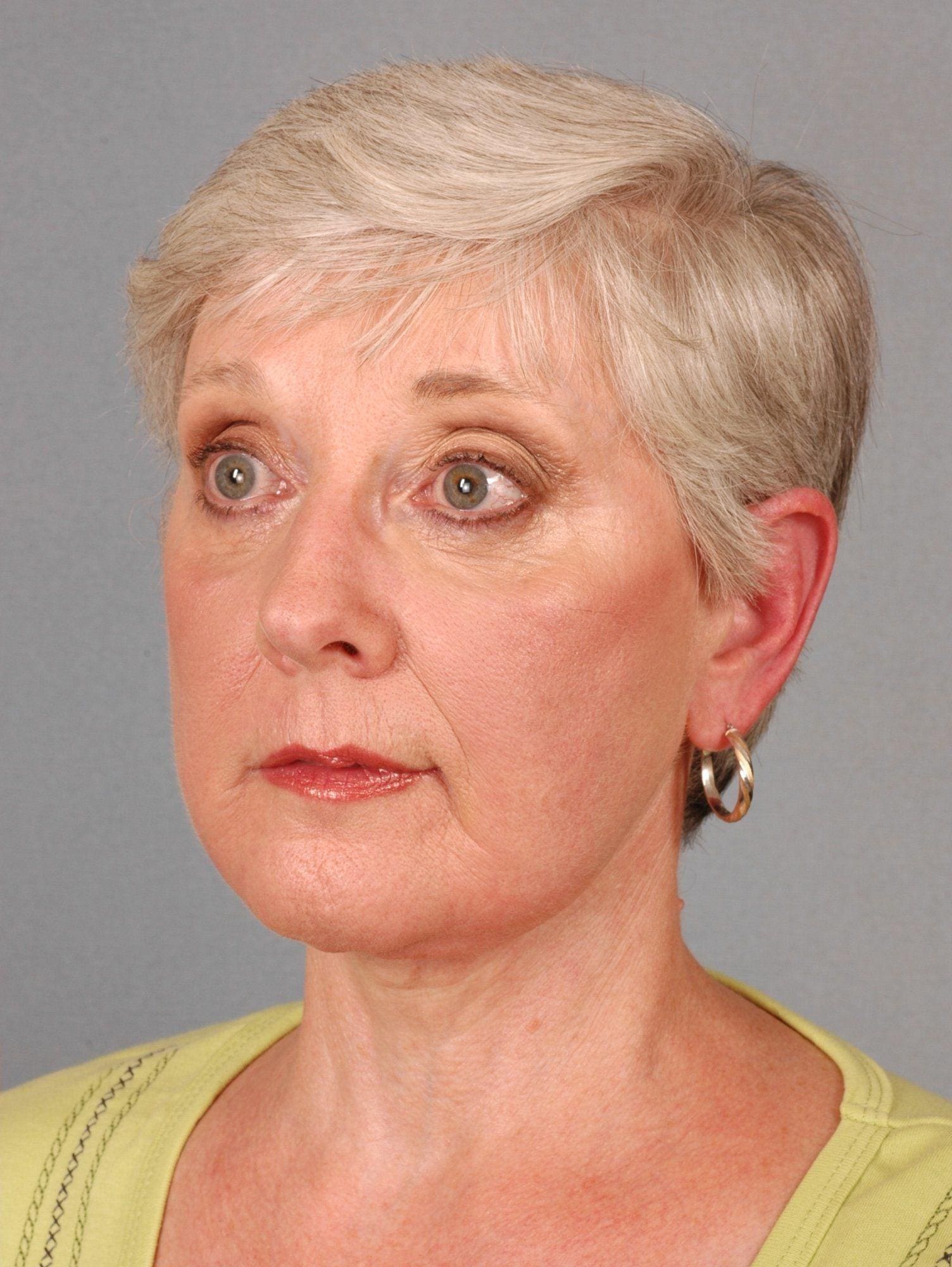 Facelift Patient Photo - Case 15251 - after view-1