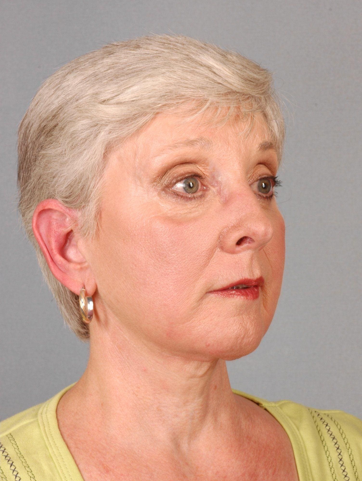 Facelift Patient Photo - Case 15251 - after view-2
