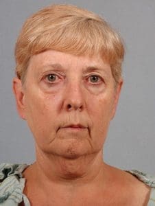 Facelift - Case 15251 - Before