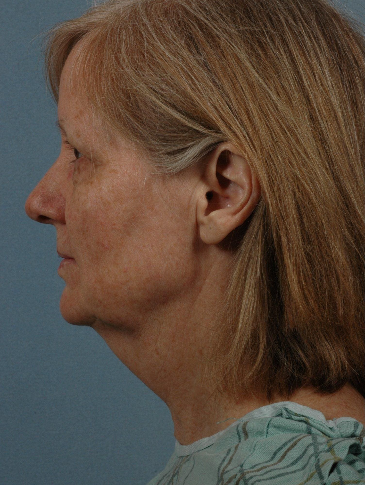 Facelift Patient Photo - Case 15259 - before view-1
