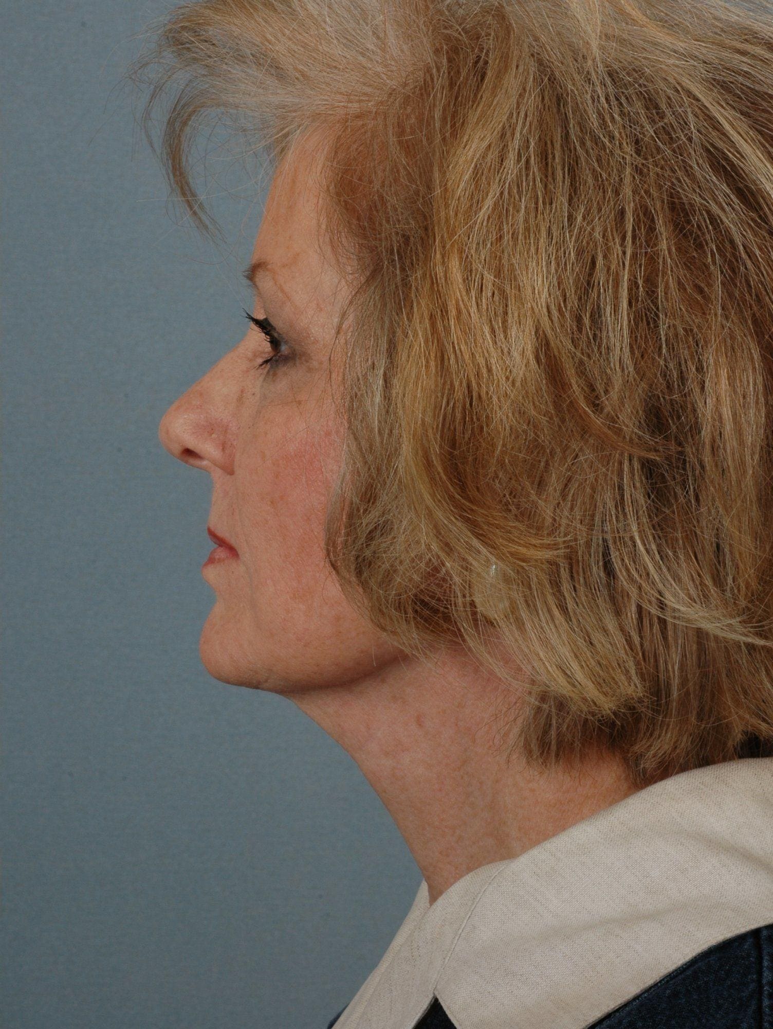 Facelift Patient Photo - Case 15259 - after view-1