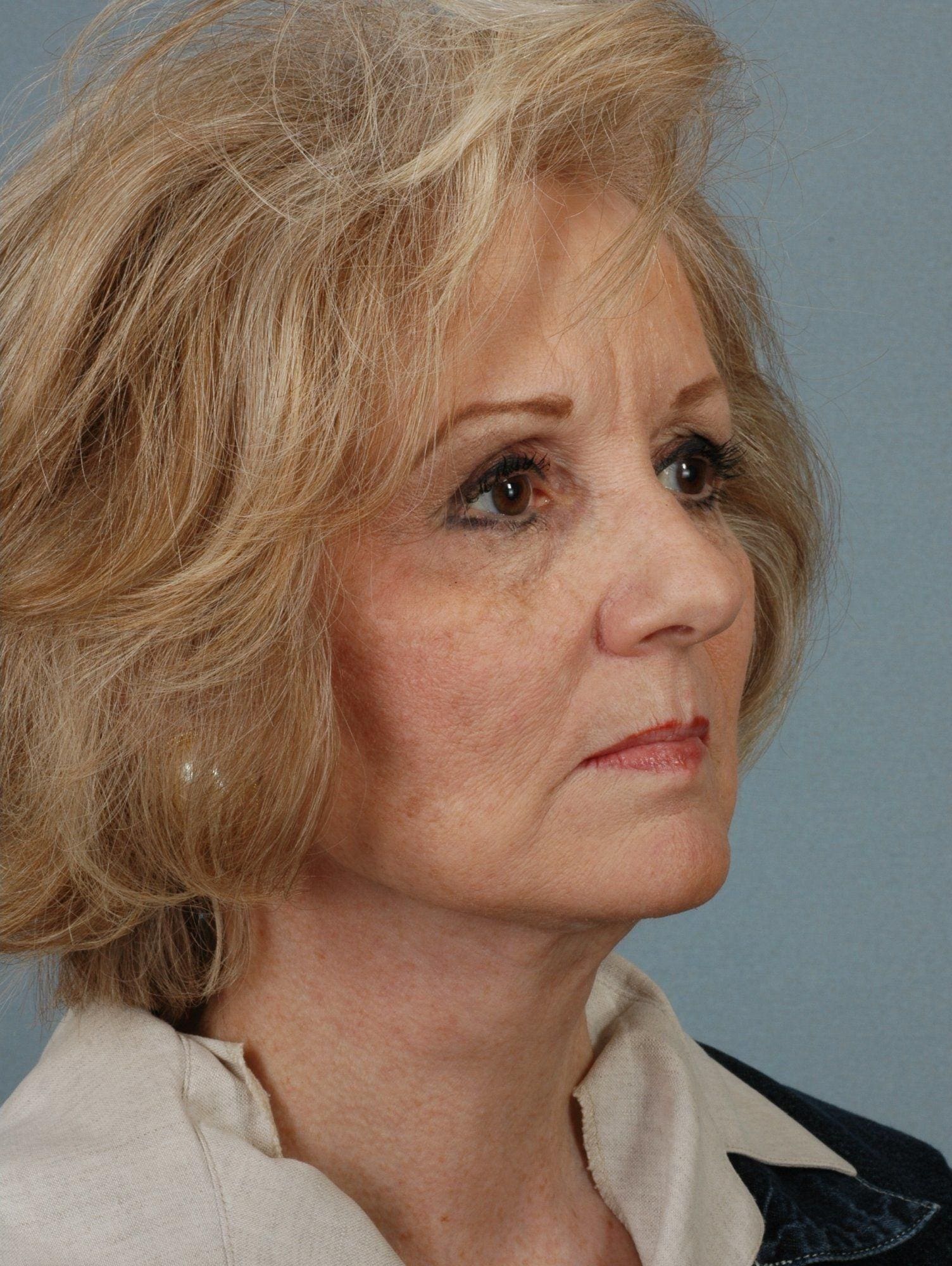 Facelift Patient Photo - Case 15259 - after view-4