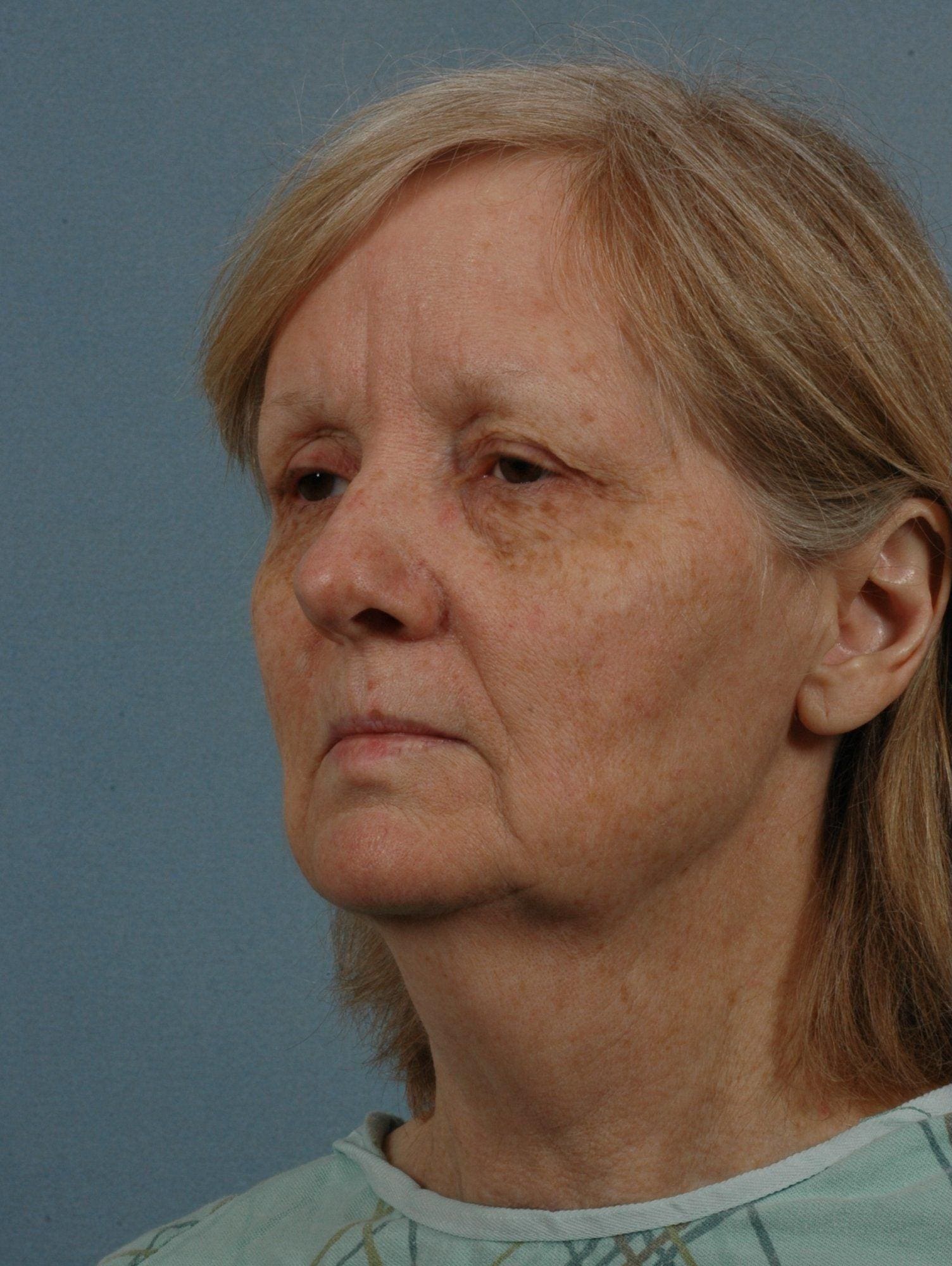 Facelift Patient Photo - Case 15259 - before view-3