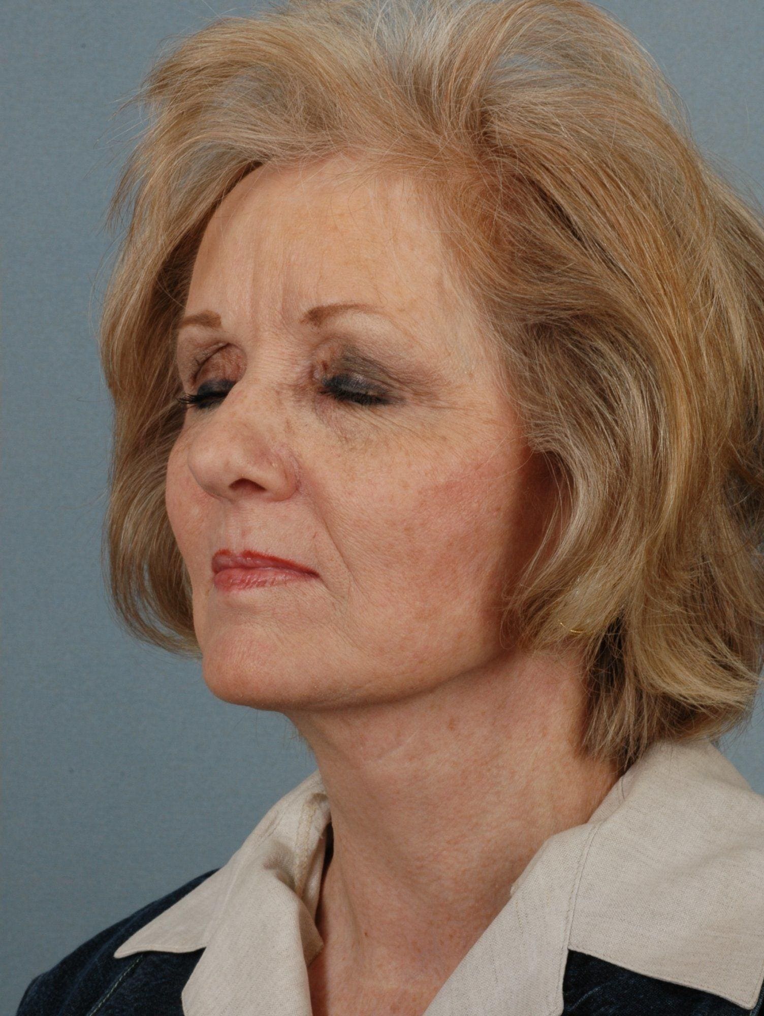 Facelift Patient Photo - Case 15259 - after view-3