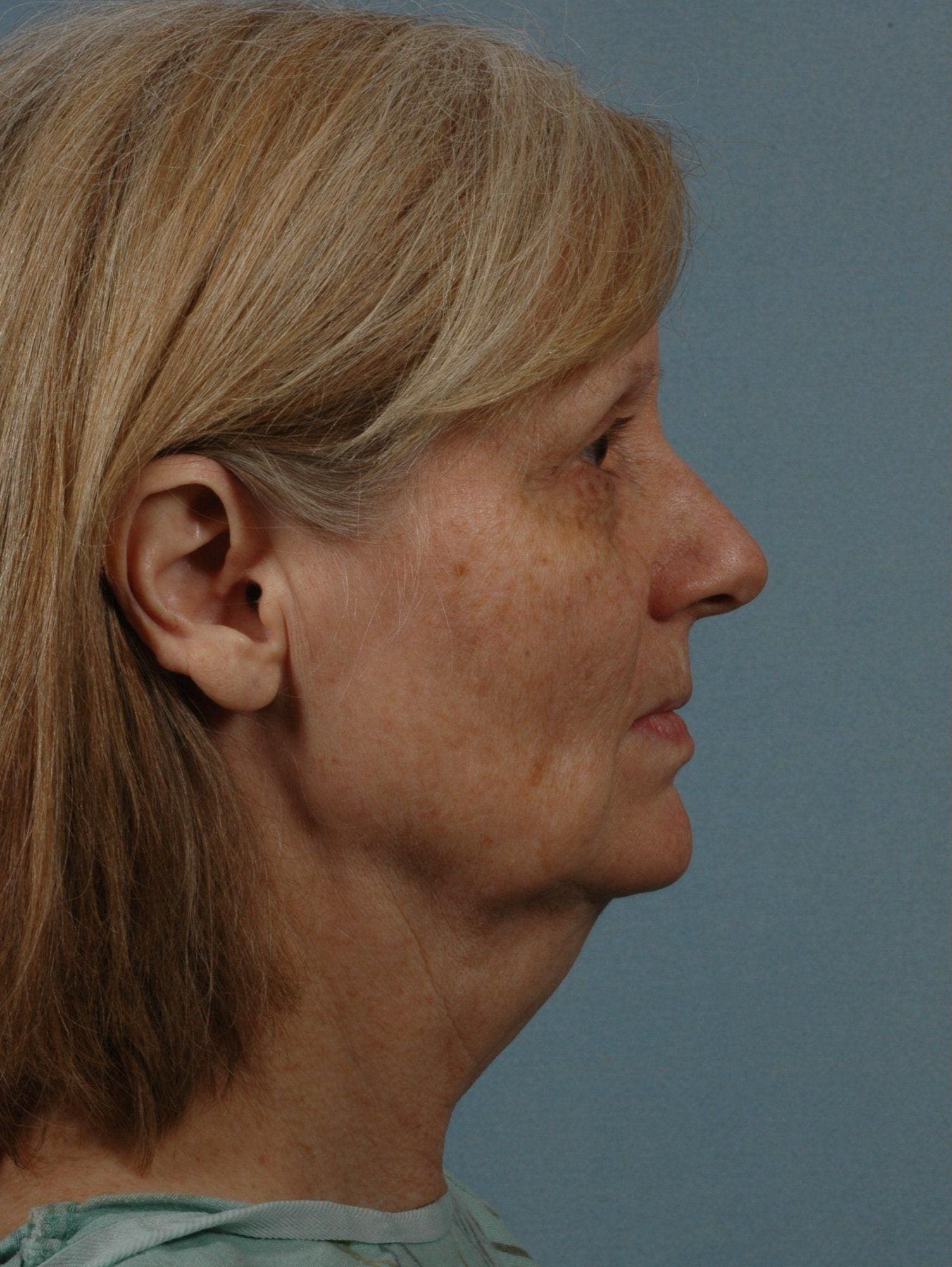 Facelift Patient Photo - Case 15259 - before view-2