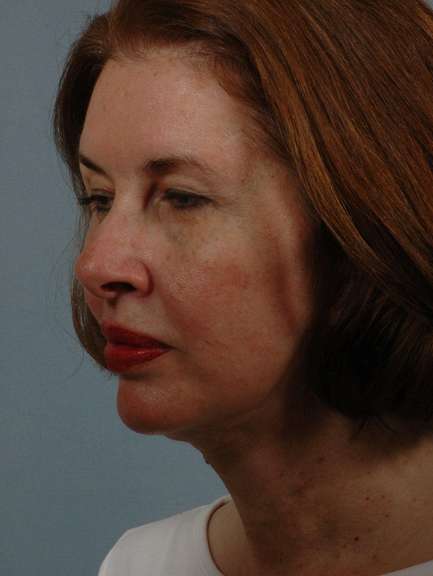Facelift Patient Photo - Case 15271 - after view-3