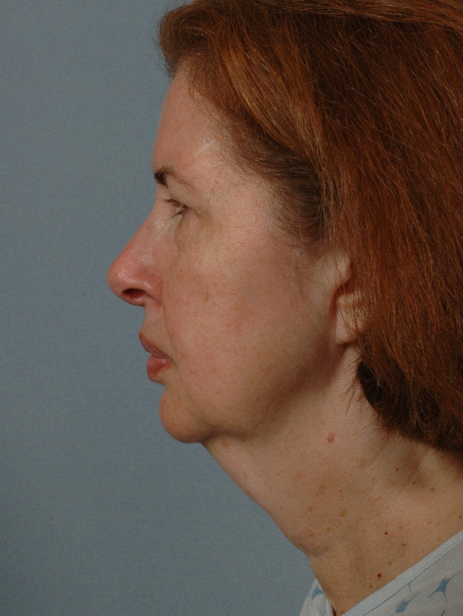 Facelift Patient Photo - Case 15271 - before view-1