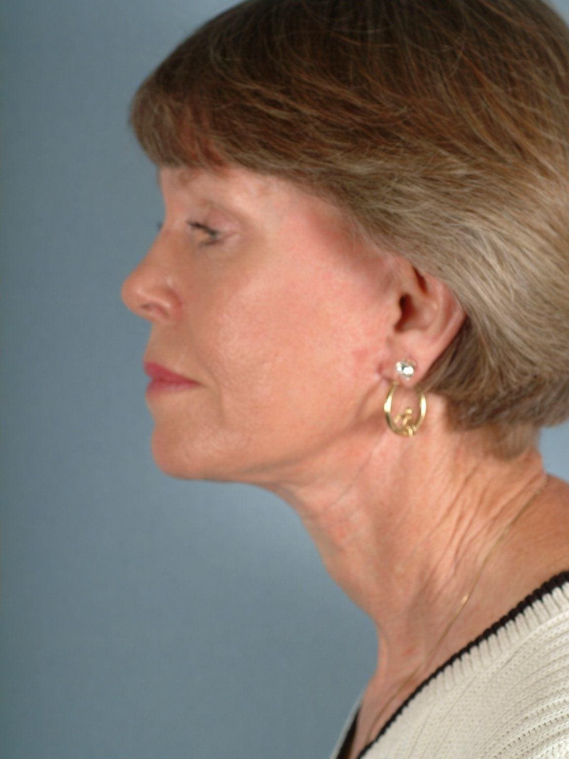 Facelift Patient Photo - Case 15283 - after view-1