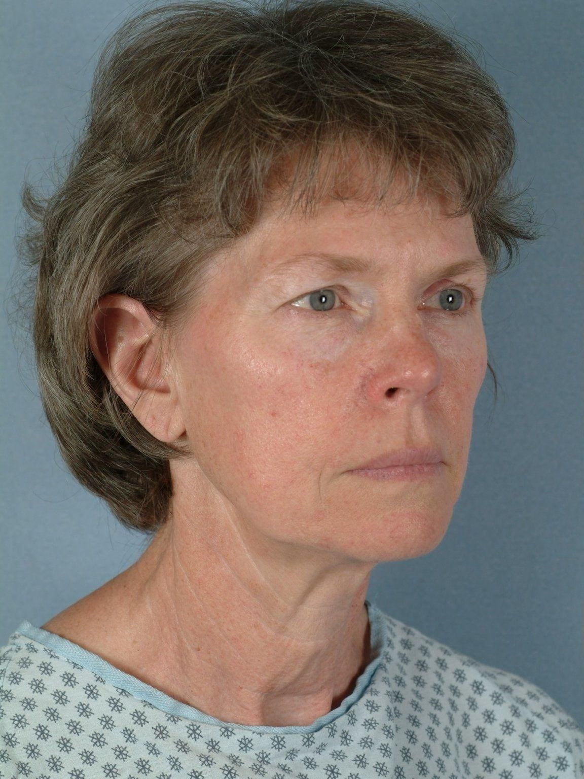 Facelift Patient Photo - Case 15283 - before view-4