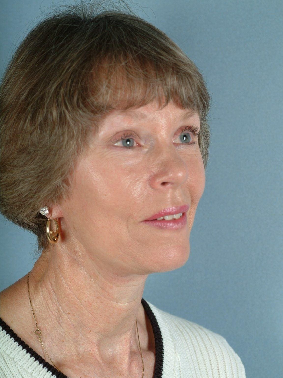 Facelift Patient Photo - Case 15283 - after view-4