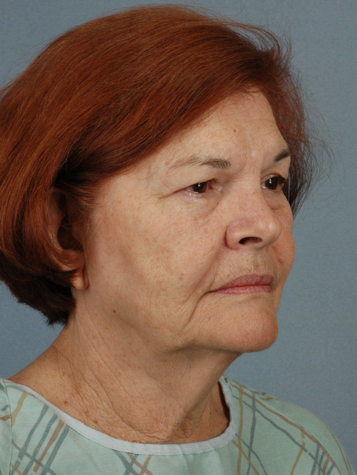 Facelift Patient Photo - Case 15295 - before view-4