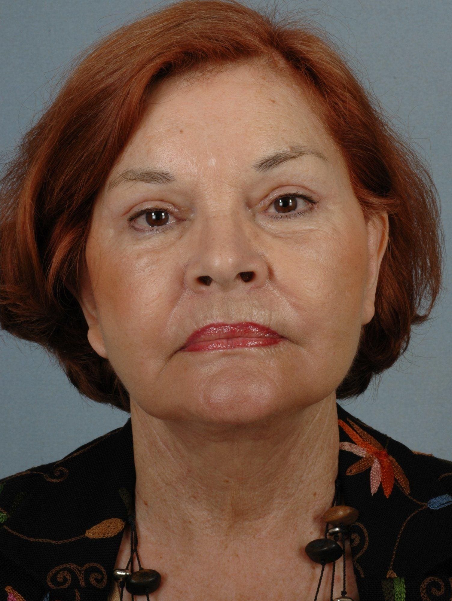 Facelift Patient Photo - Case 15295 - after view