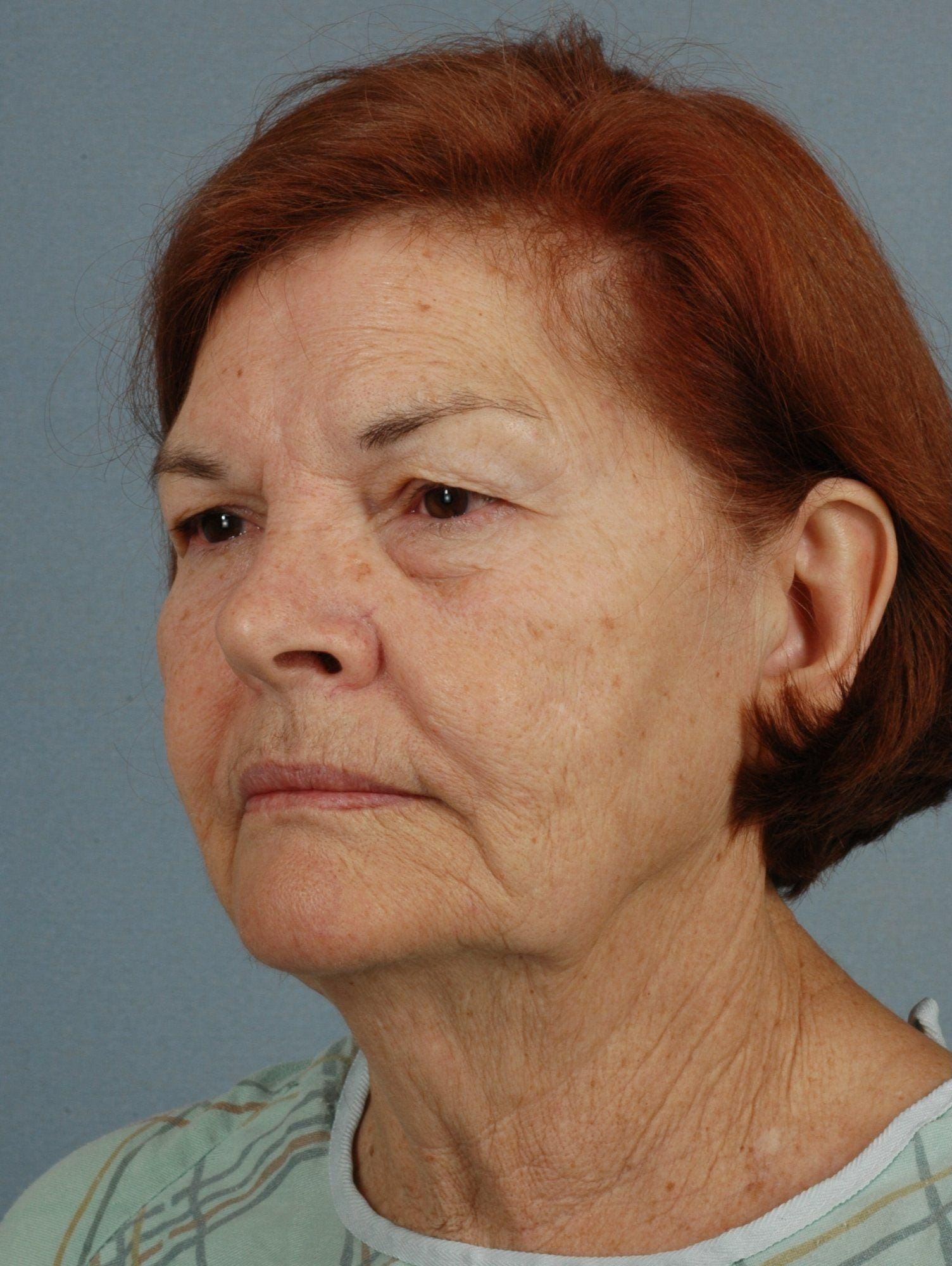Facelift Patient Photo - Case 15295 - before view-3