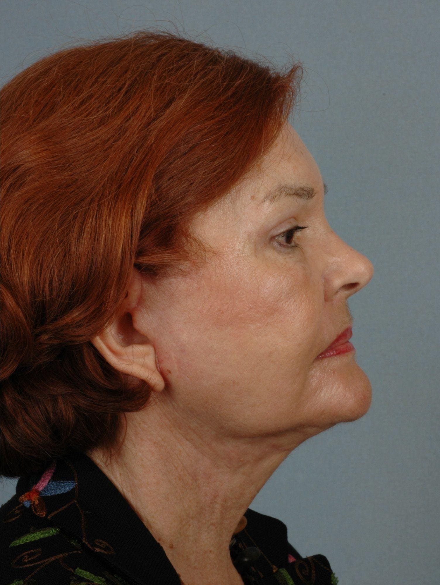 Facelift Patient Photo - Case 15295 - after view-2