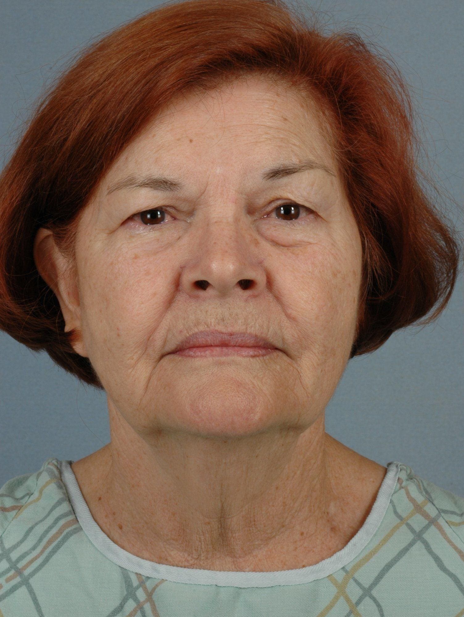 Facelift Patient Photo - Case 15295 - before view-