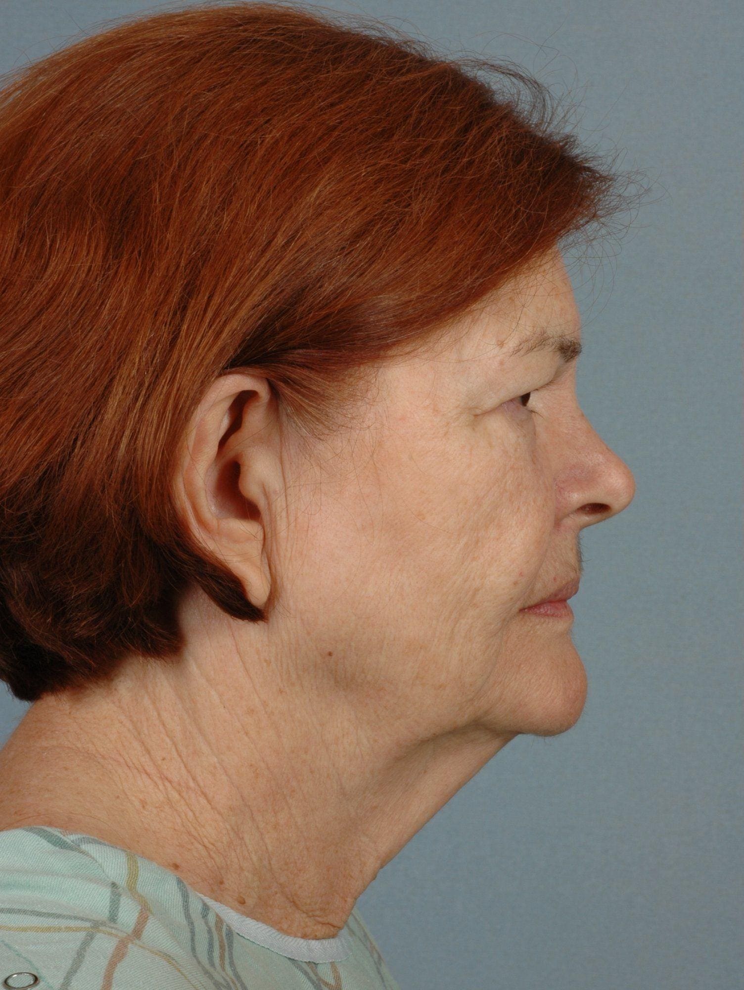 Facelift Patient Photo - Case 15295 - before view-2