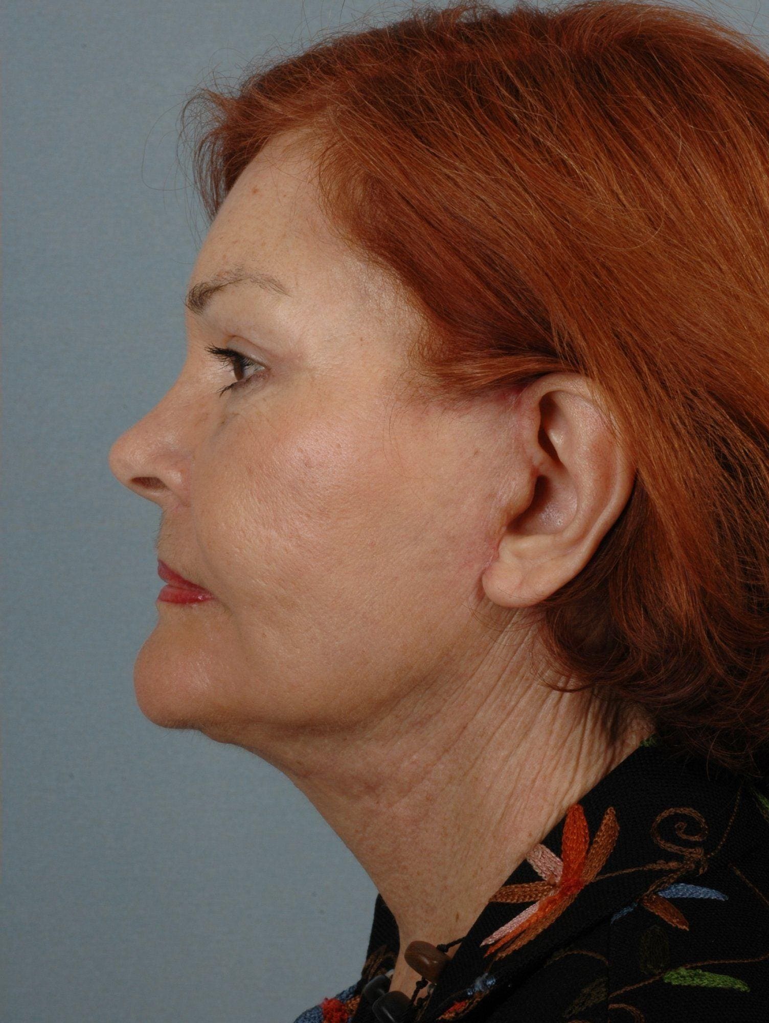 Facelift Patient Photo - Case 15295 - after view-1