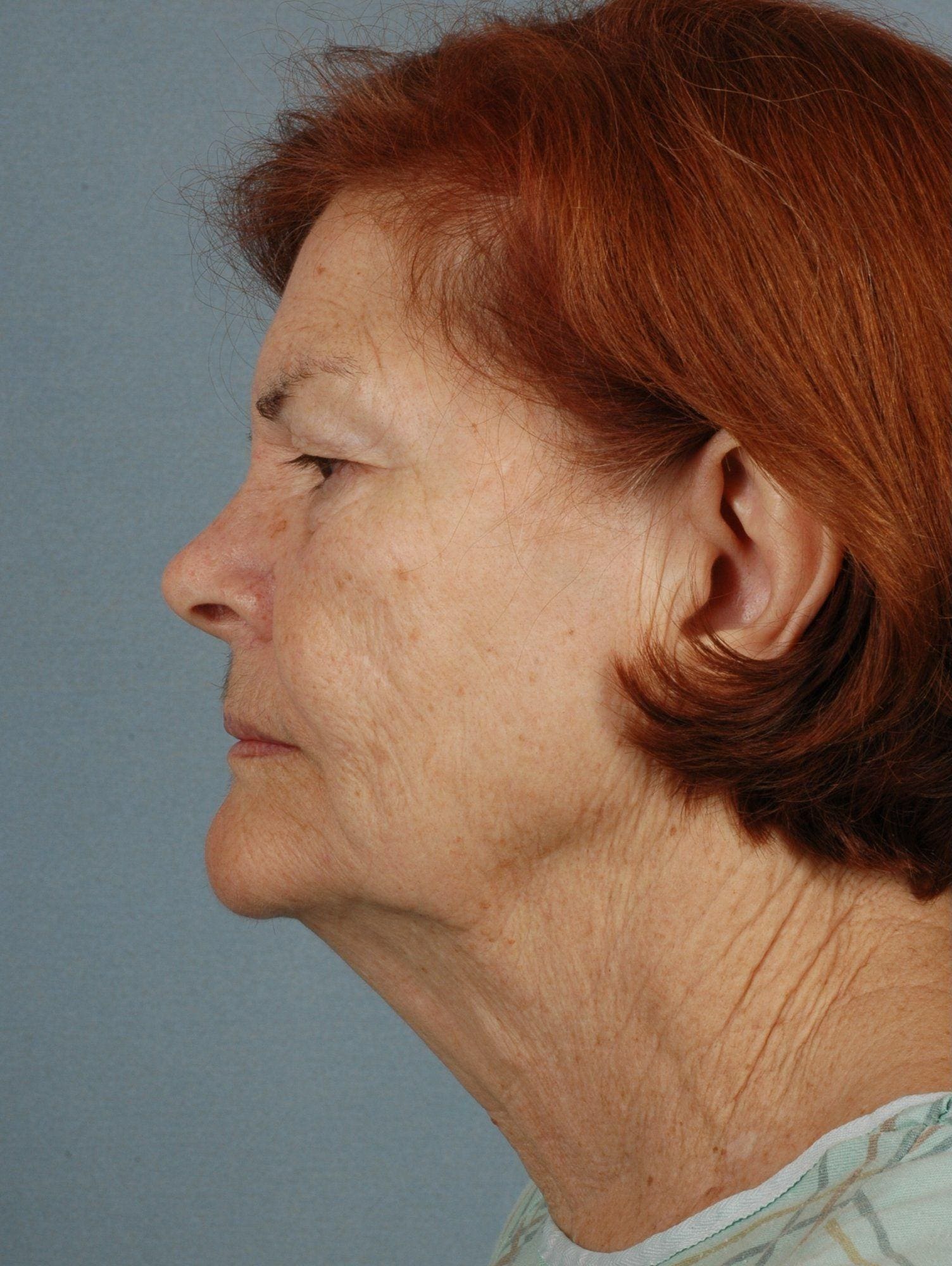 Facelift Patient Photo - Case 15295 - before view-1