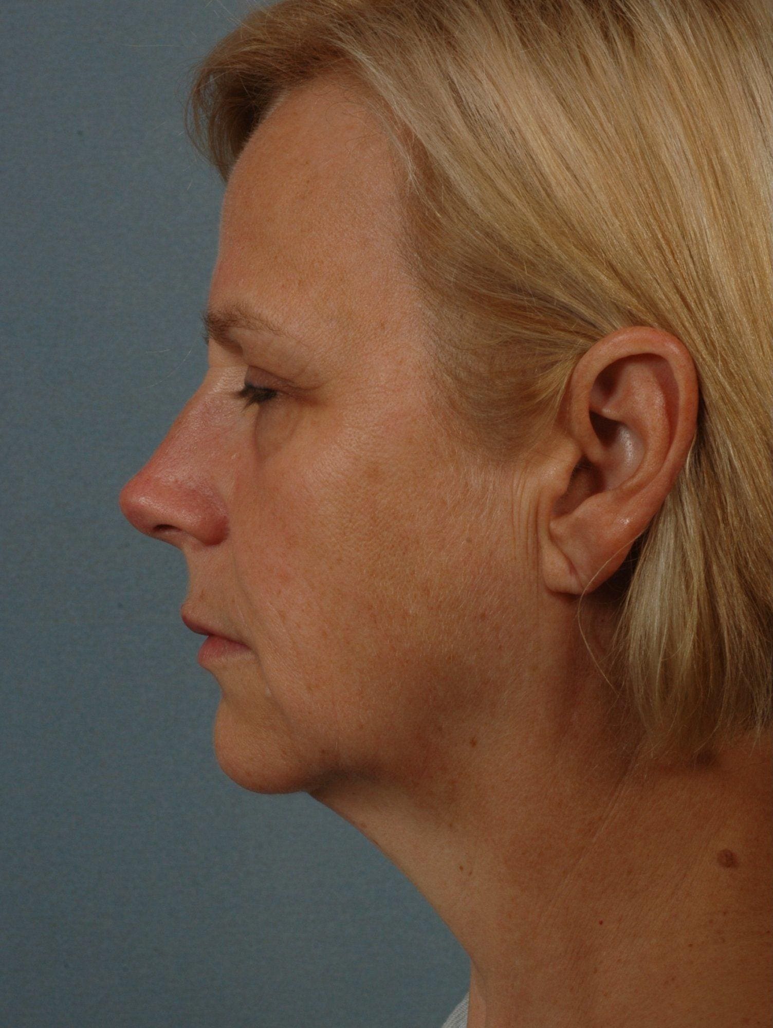 Facelift Patient Photo - Case 15307 - before view-1
