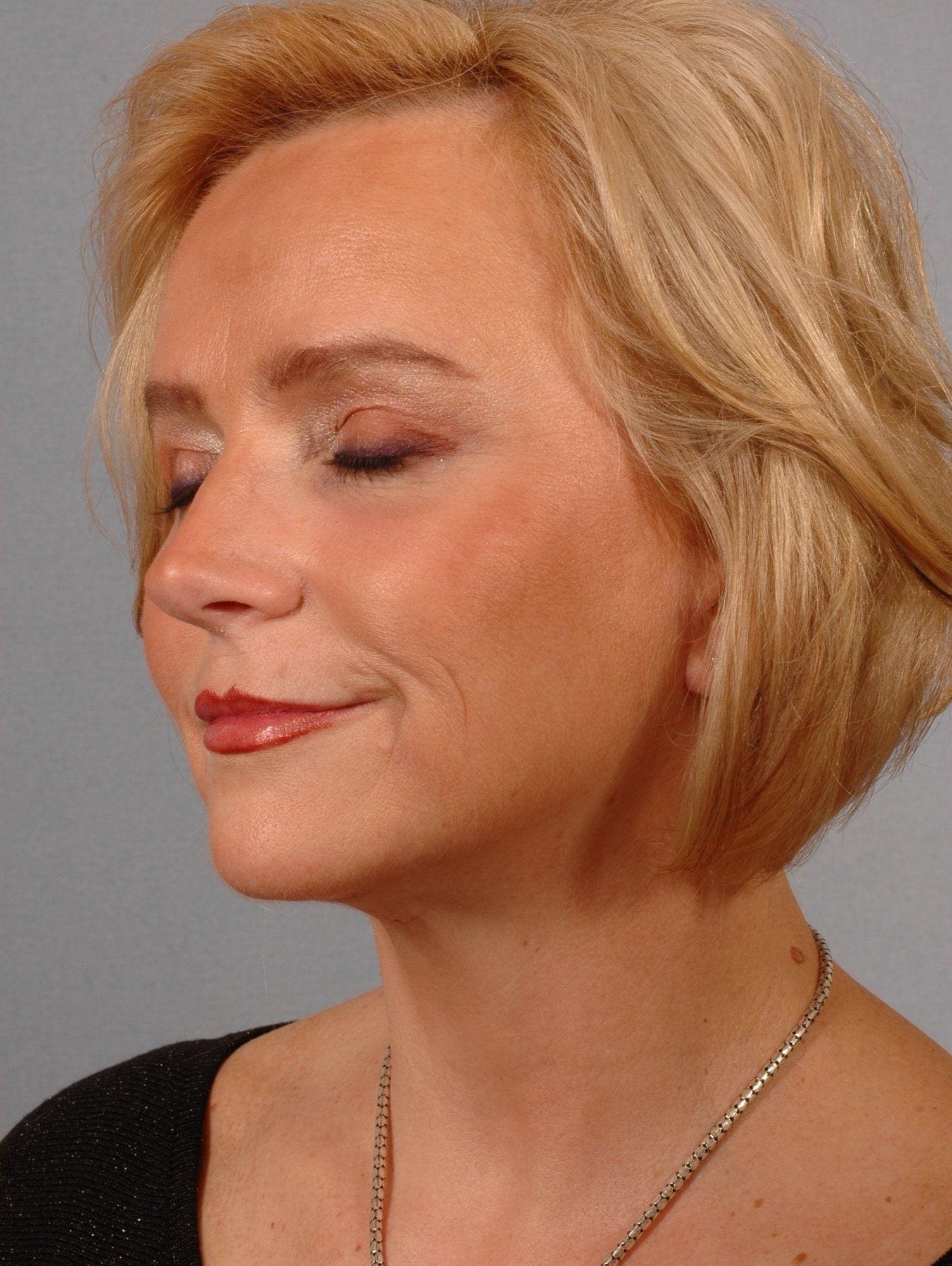 Facelift Patient Photo - Case 15307 - after view-3