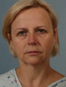 Facelift - Case 15307 - Before