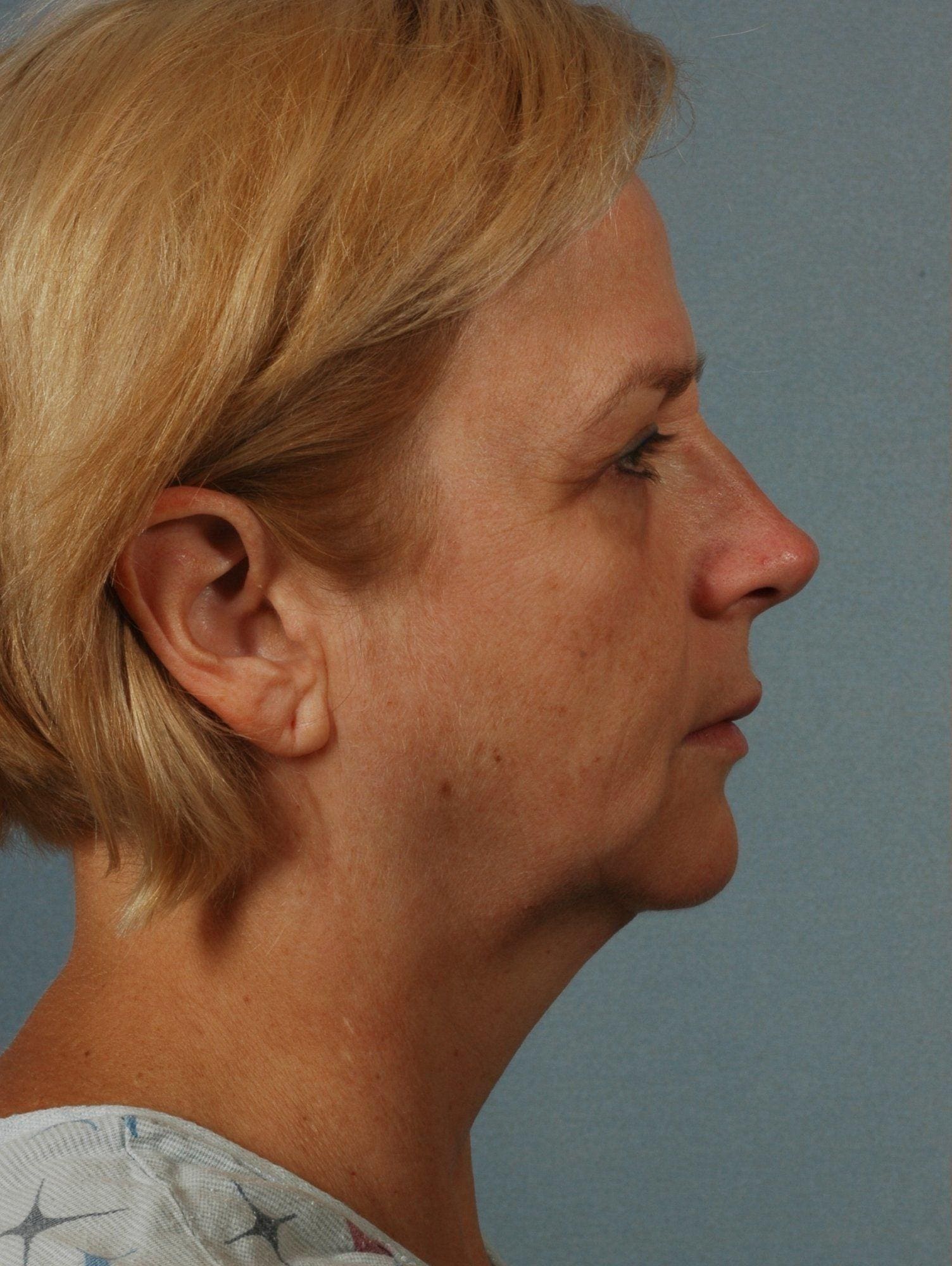 Facelift Patient Photo - Case 15307 - before view-2