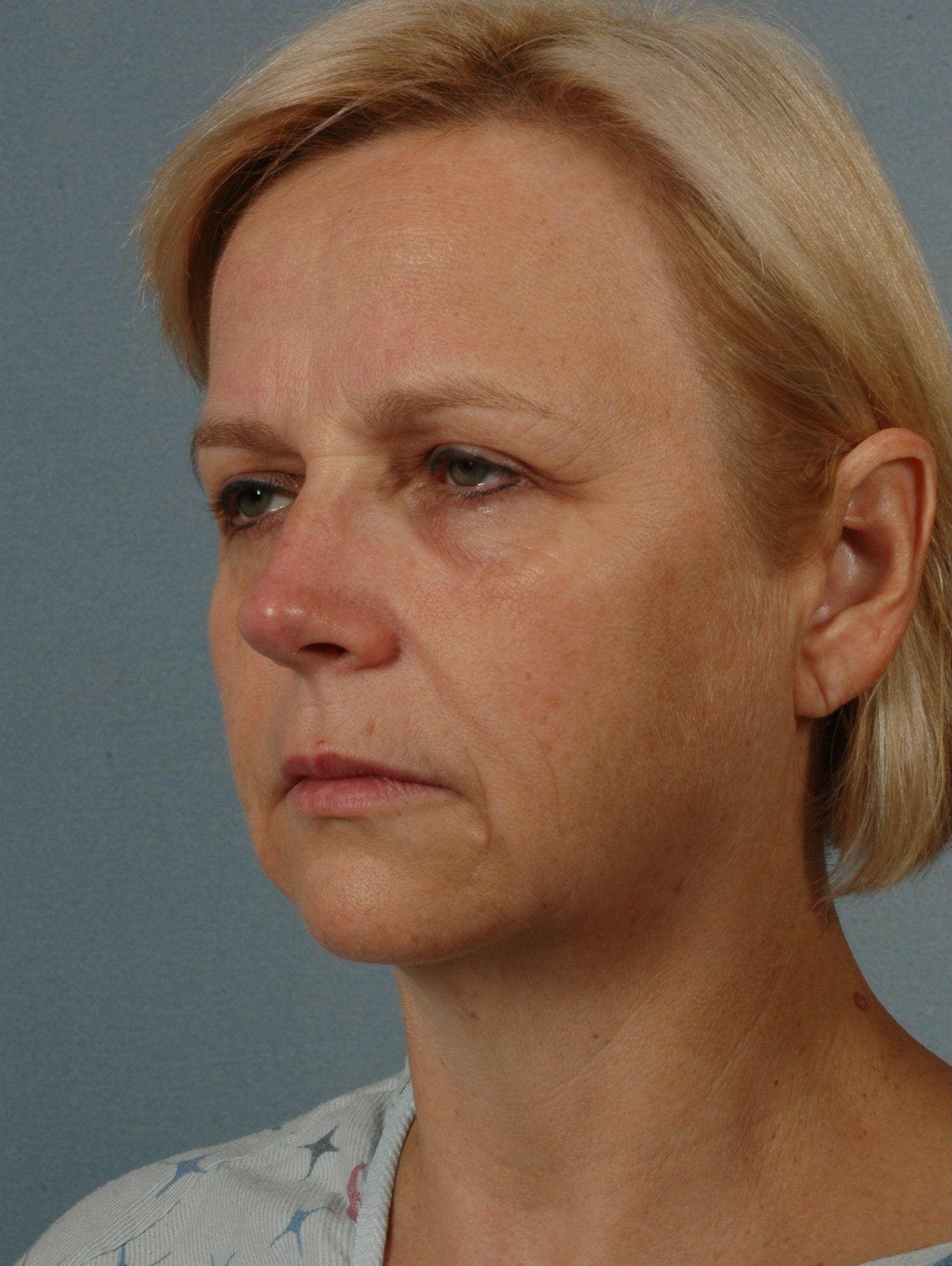 Facelift Patient Photo - Case 15307 - before view-3