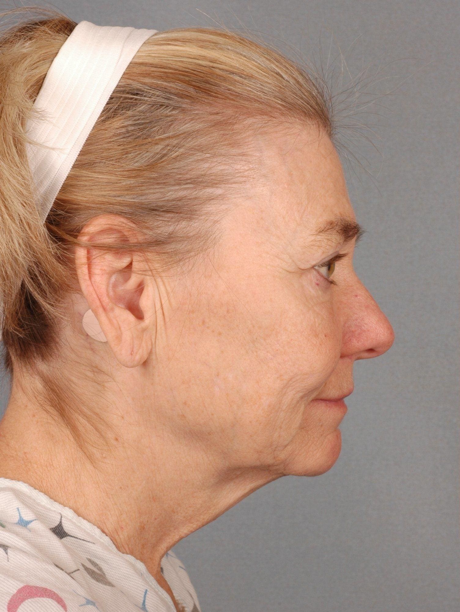 Facelift Patient Photo - Case 15320 - before view-1
