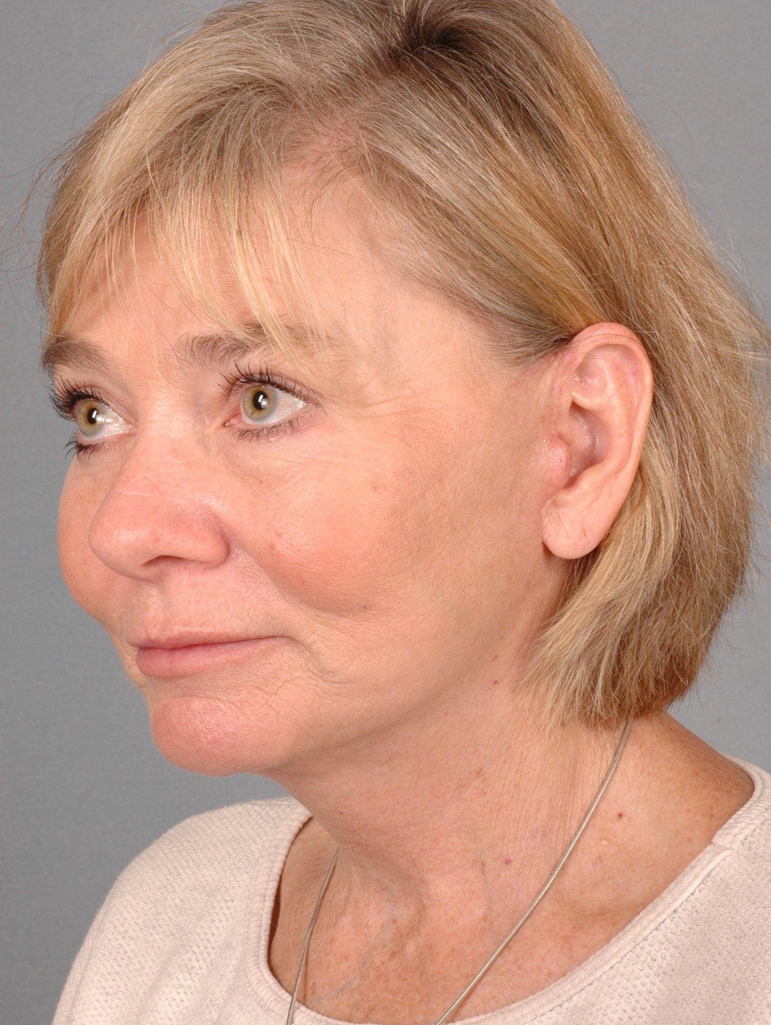 Facelift Patient Photo - Case 15320 - after view-2