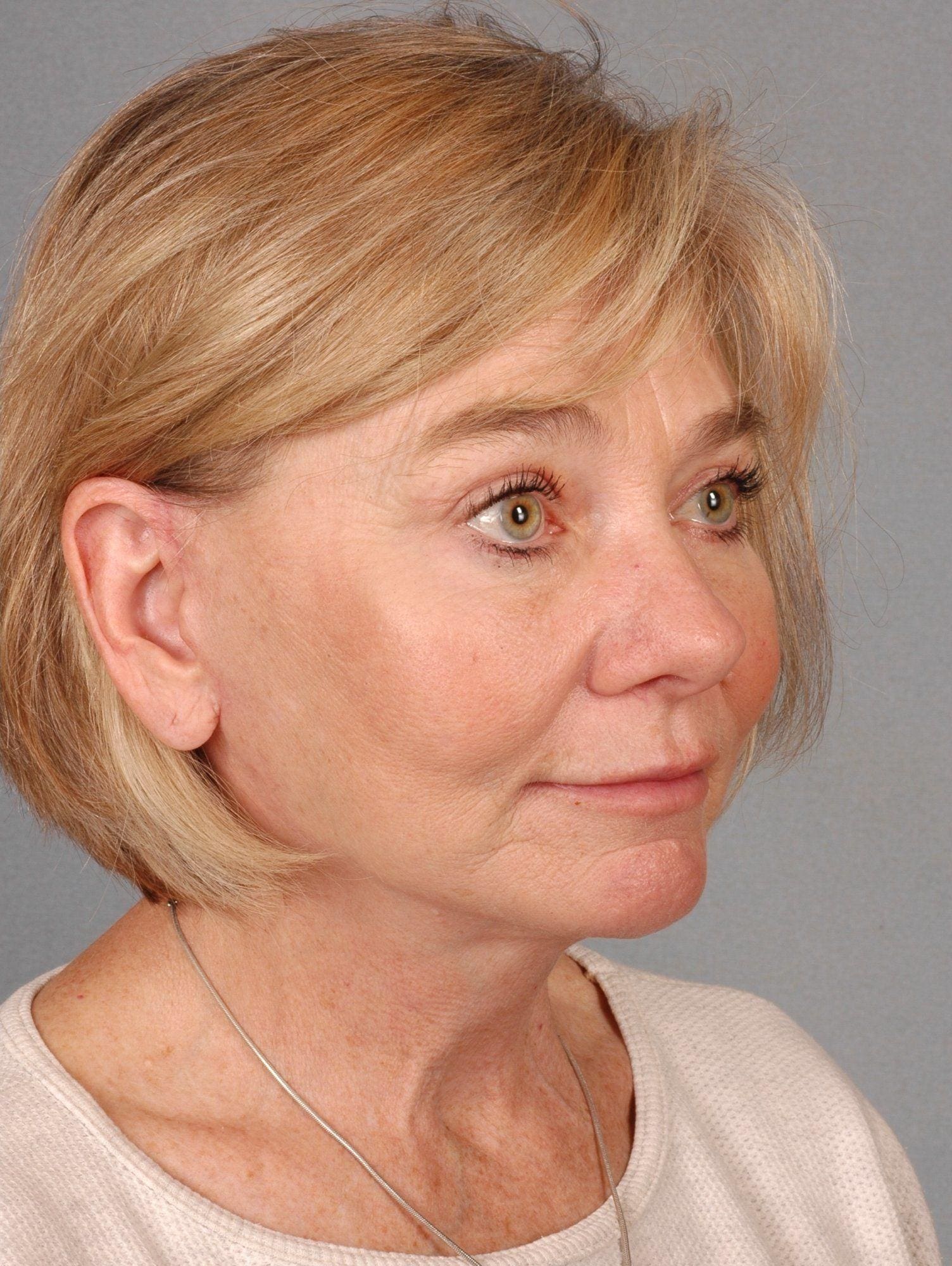 Facelift Patient Photo - Case 15320 - after view-3