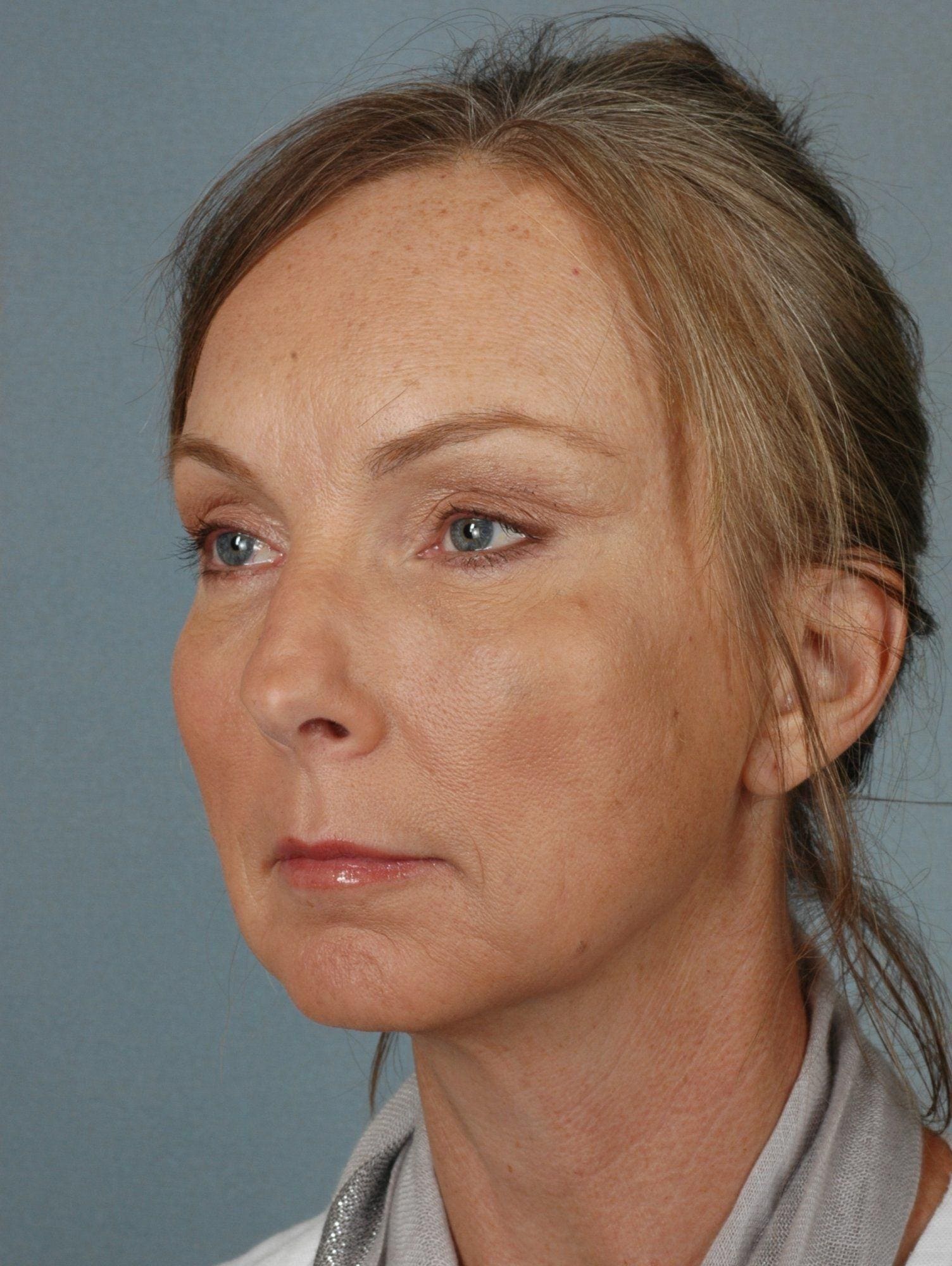 Facelift Patient Photo - Case 15330 - after view-3