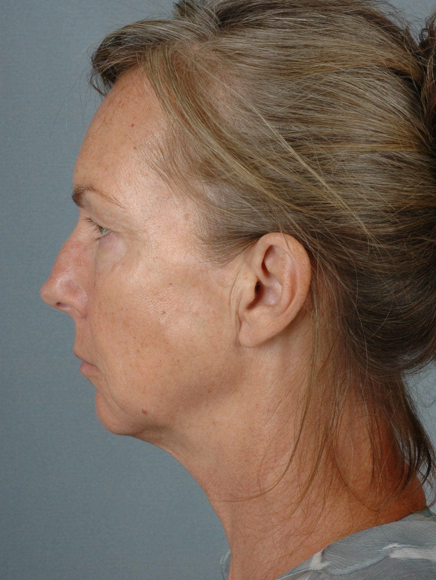 Facelift Patient Photo - Case 15330 - before view-1