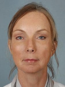 Facelift - Case 15330 - After