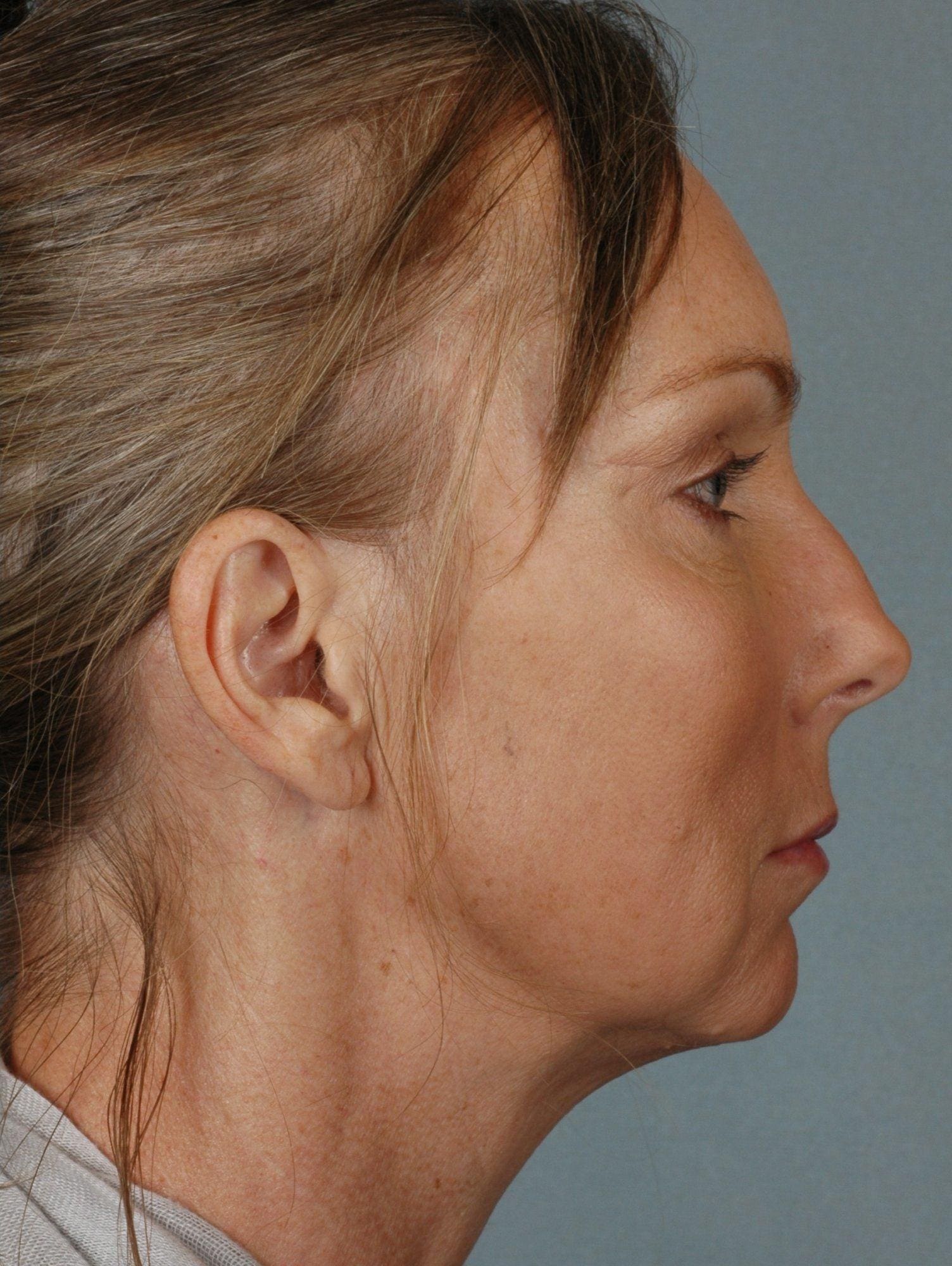 Facelift Patient Photo - Case 15330 - after view-2
