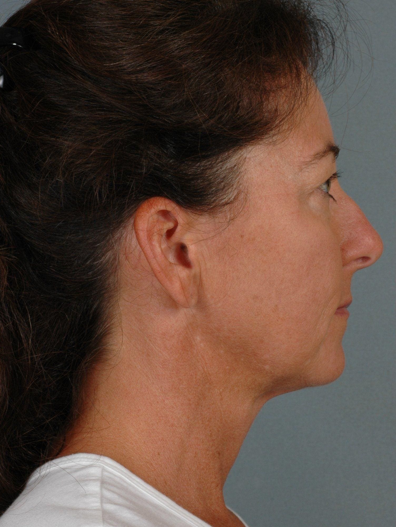 Facelift Patient Photo - Case 15342 - before view-2
