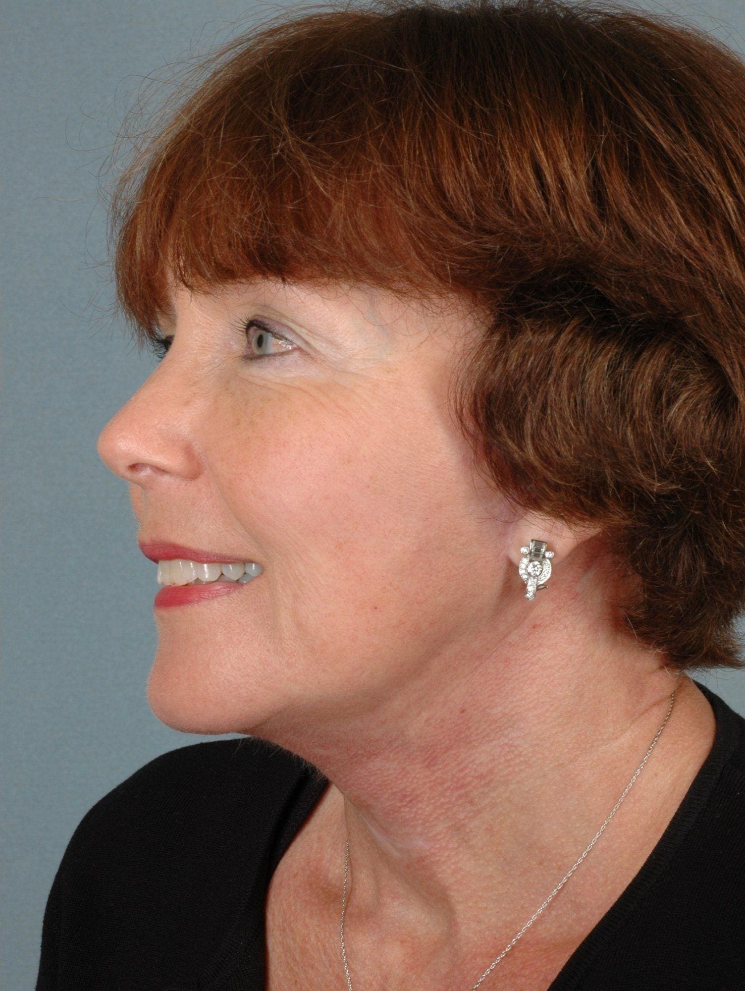 Facelift Patient Photo - Case 15356 - after view-3