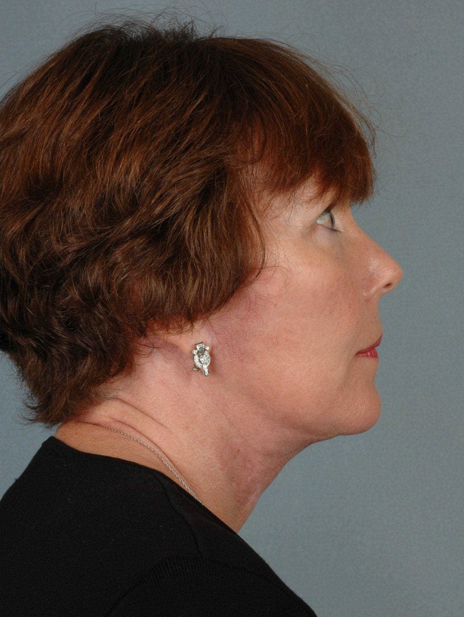 Facelift Patient Photo - Case 15356 - after view-2